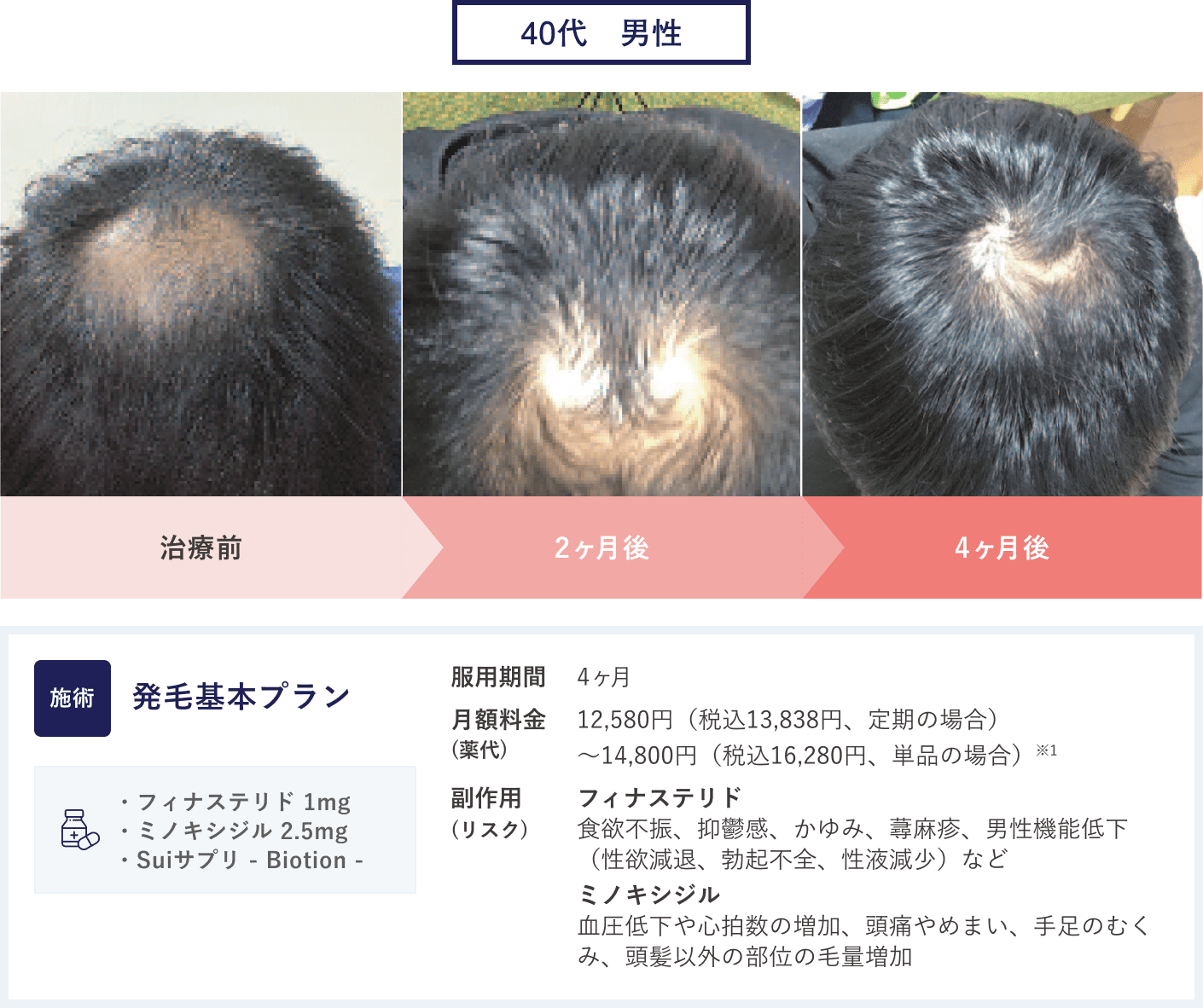 27歳男性のAGA治療「発毛基本プラン」の症例
