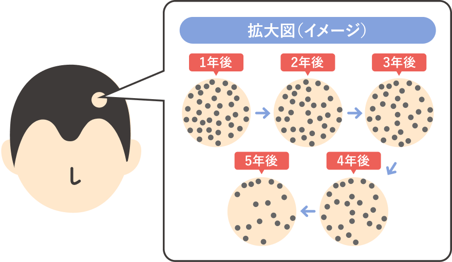 AGAの進行イメージイラスト