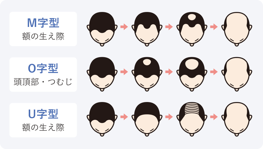 AGAの進行パターン画像