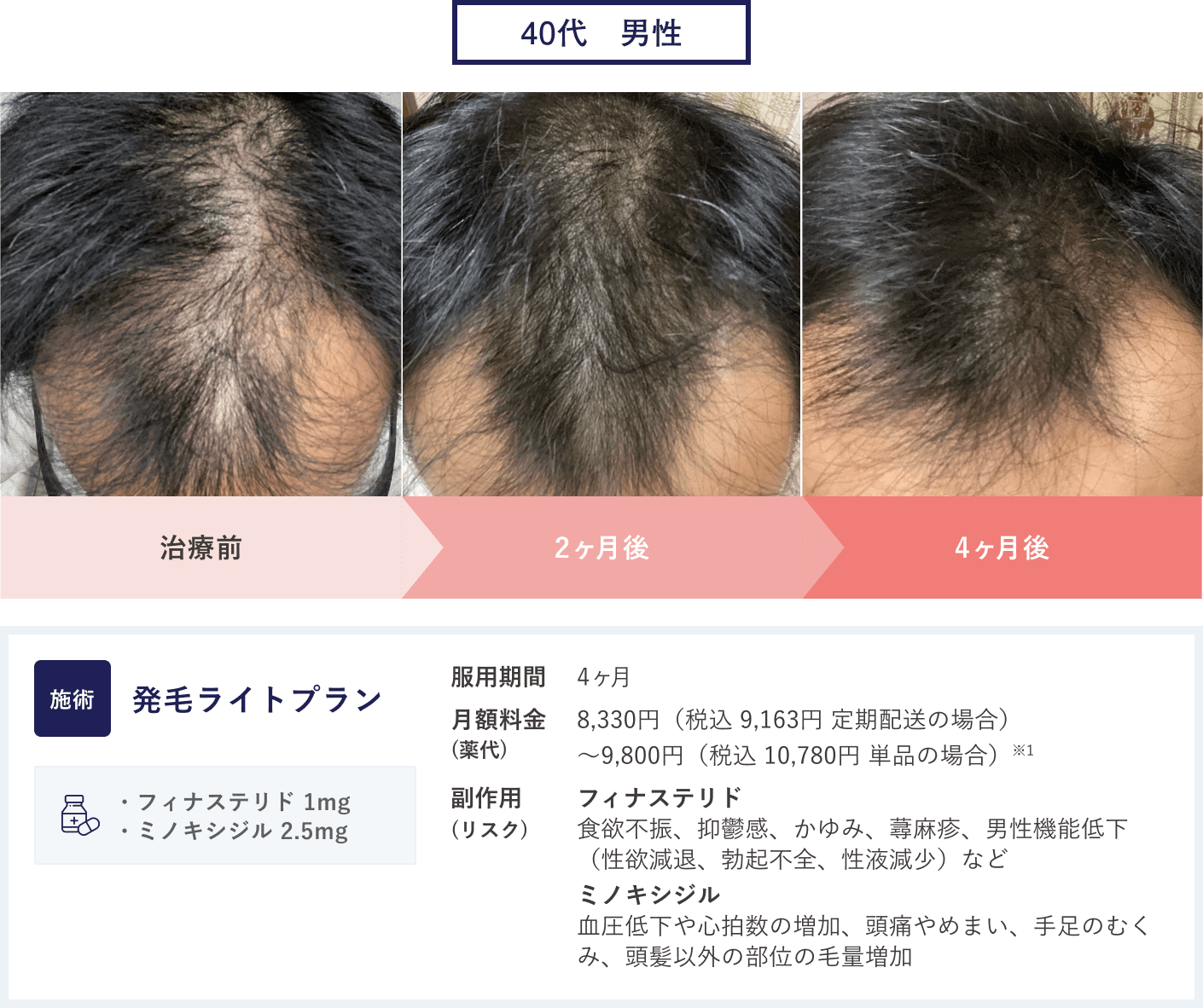 27歳男性のAGA治療「発毛ライトプラン」の症例