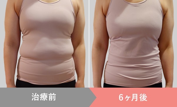 マンジャロダイエットの3ヶ月後の40代女性のビフォーアフター