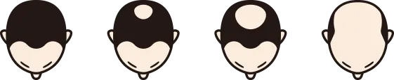 頭頂部