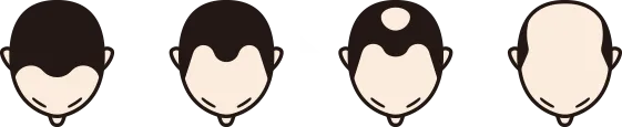 生え際