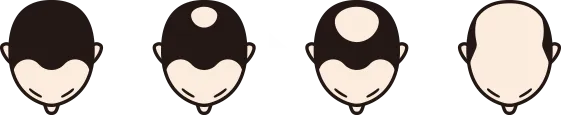 頭頂部