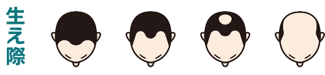 生え際から進行するタイプ