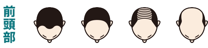 前頭部から進行するタイプ