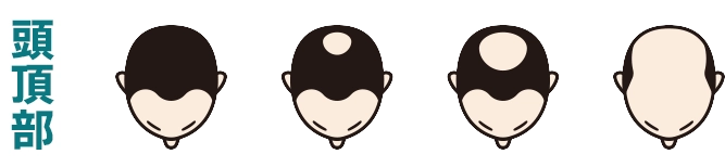 頭頂部から進行するタイプ