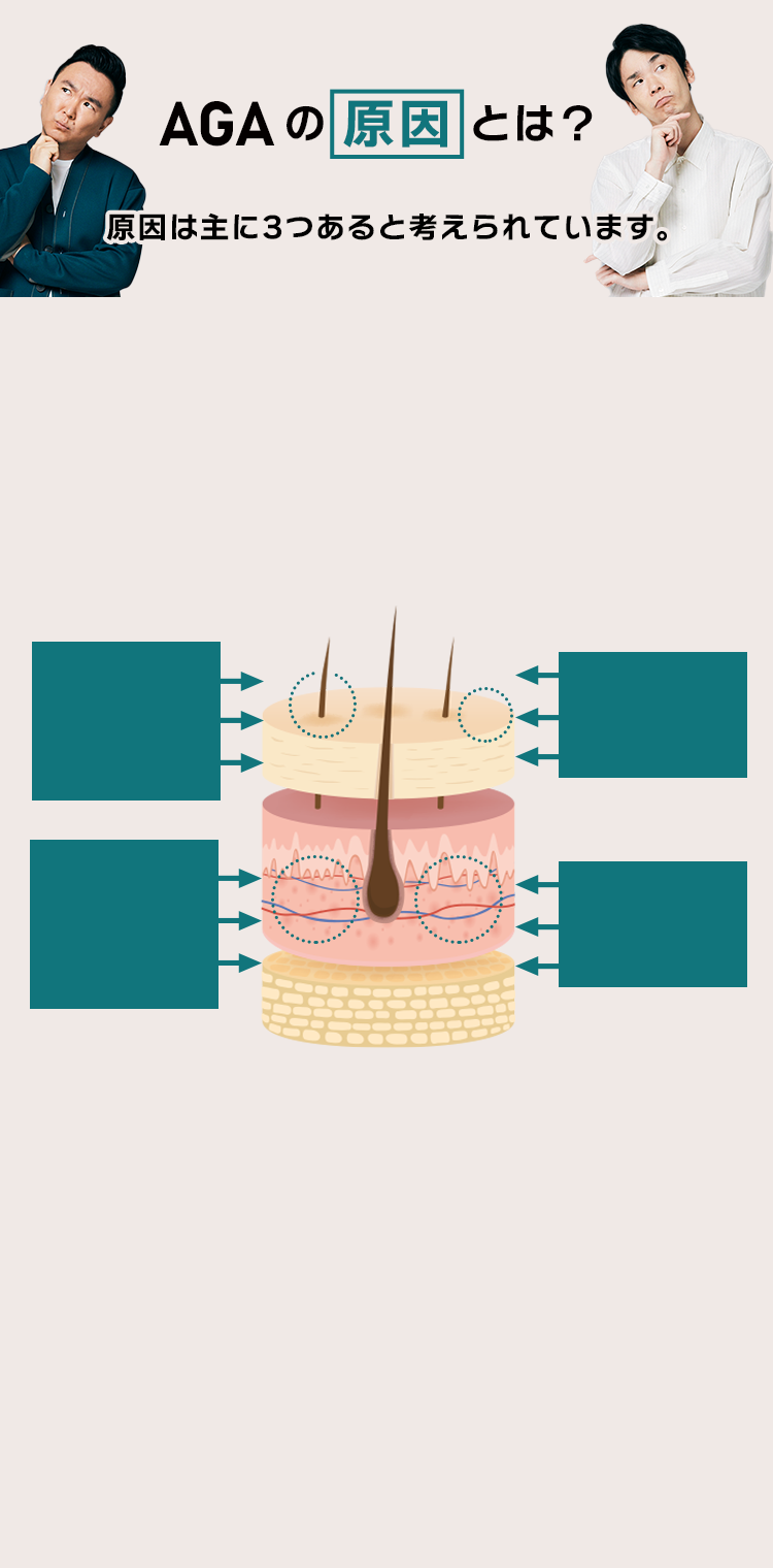 AGAの原因とは？