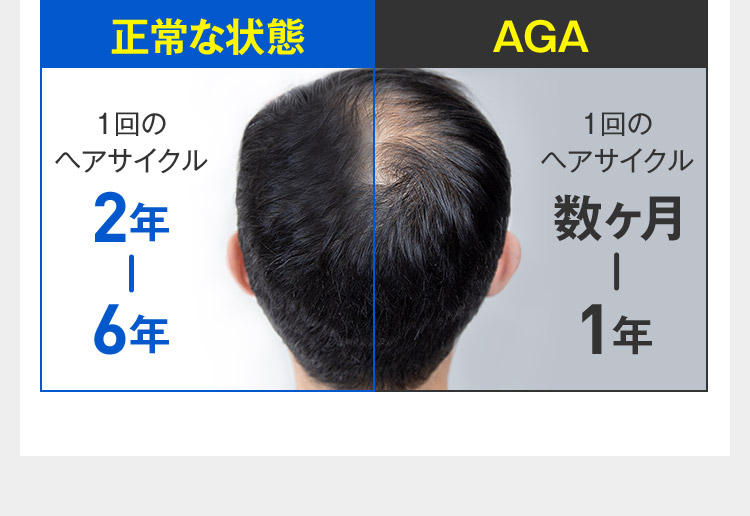 正常な状態 1回のヘアサイクル 2年から6年 AGA 1回のヘアサイクル 数ヶ月から1年