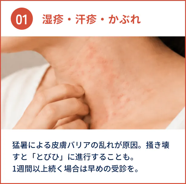 湿疹・汗疹・かぶれ