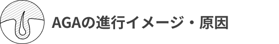 AGAの進行イメージ・原因
