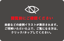 カンジダ男性