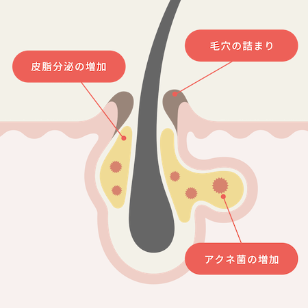 ニキビの原因としくみ