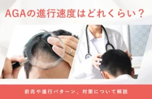 AGAの進行速度や薄毛が進行する期間の目安を解説する画像