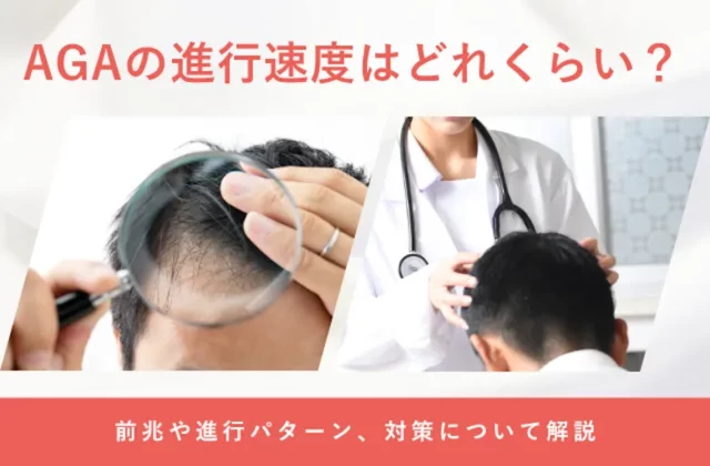 AGAの進行速度や薄毛が進行する期間の目安を解説する画像
