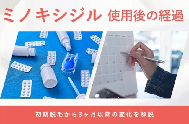ミノキシジルを3ヶ月使用した場合の効果や変化の目安を解説する画像