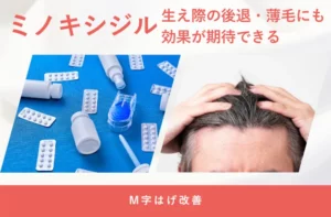 ミノキシジルの生え際への効果や使用時のポイントを解説する画像