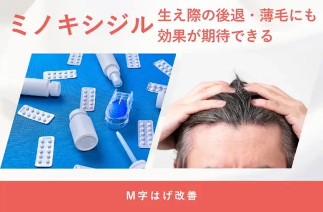 ミノキシジルの生え際への効果や使用時のポイントを解説する画像