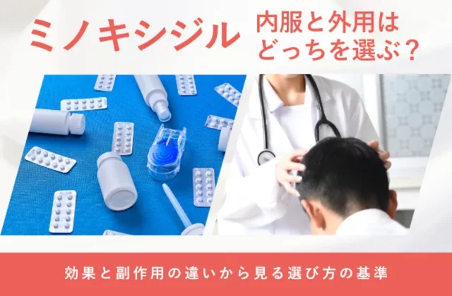 ミノキシジルの内服薬と外用薬の違いや選び方を解説する画像