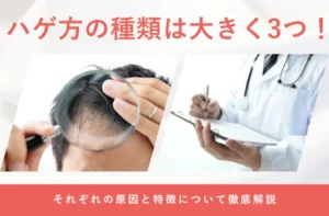 薄毛やハゲ方の種類と特徴の違いを解説する画像